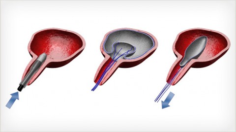 Maternal and Infant Health: Creating an Intrauterine Device to Control Postpartum Bleeding